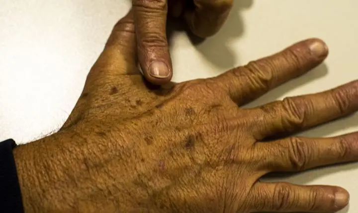 Desinformação sobre câncer de pele afeta diagnóstico, diz instituição